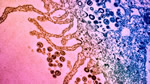 Photo: HIV attacking cells in purple pink and red - Credit: Michael Mashiba M.D., Ph.D., and Stephanie King
