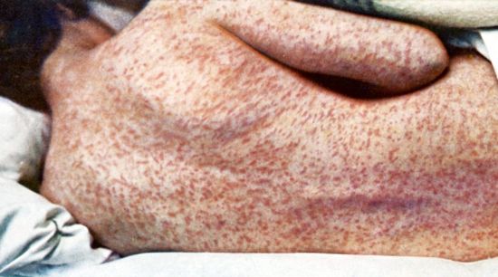 Photo: Back of female with measles. Wellcome / Wikimedia Commons Back of female with measles. Wellcome / Wikimedia Commons