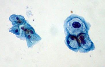 Healthy cervical cells on the left and infected with HPV on the right. / Euthman