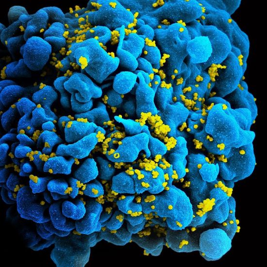 Scanning electromicrograph of an HIV-infected H9 T cell.
