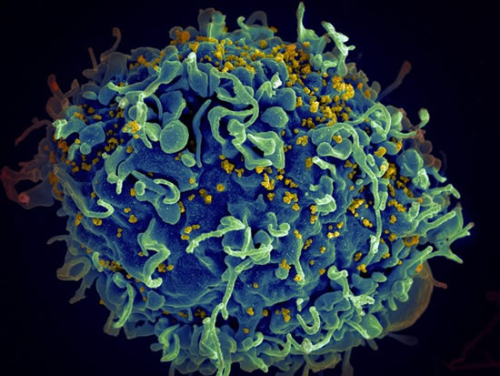 HIV virus (yellow) infecting a human cell. Credit: National Cancer Institute