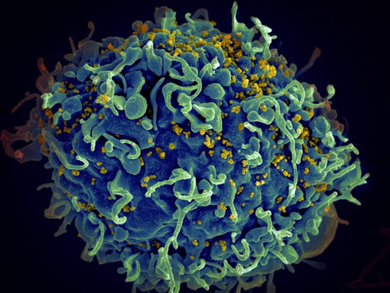HIV virus (yellow) infecting a human cell. Credit: National Cancer Institute HIV virus (yellow) infecting a human cell. Credit: National Cancer Institute