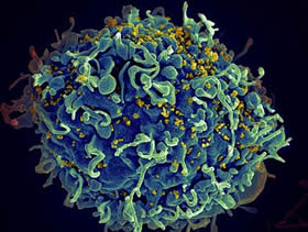 Human cell (blue) infected with HIV (yellow)