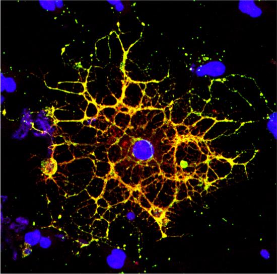A confocal microscope image shows an oligodendrocyte in cell culture, labeled to show the cell nucleus in blue and myelin proteins in red, green, and yellow. Researchers from Penn and CHOP have shown that HIV infection prevents oligodendrocytes from maturing, leading to a reduction in white matter in the brain.(Image: Raj Putatunda)