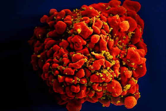 A T cell infected with HIV