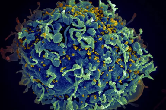  A human T cell, in blue, under attack by HIV, in yellow