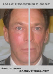 Bradford McIntyre, Facial Recunstruction with Bio-Alcamid procedure, Before & After, half procedure done. Bradford McIntyre receives Bio-alcamid treatment for lipoatrophy (facial wasting). 2004
