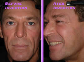 Bradford McIntyre-Bio-Alcamid procedure: Before & After Photo