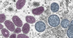 A colorized electron microscopic image shows mature, oval-shaped monkeypox virus particles (pink). Photo credit: CDC